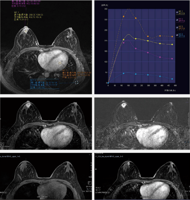 病例:乳腺钼靶检查诊断为bi-rads 1类(正常乳腺),经mri检查为bi-rads