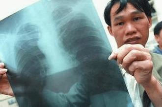 得了尘肺怎么治疗