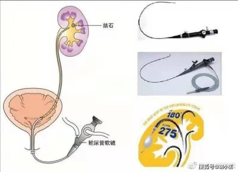 随着医学技术的进步,泌尿系结石都可以采用微创手术治疗.