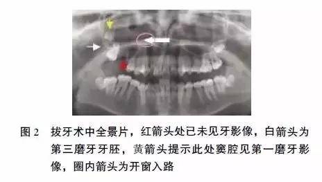 【病例分享】上颌第一磨牙全牙进入上颌窦,如何处理?