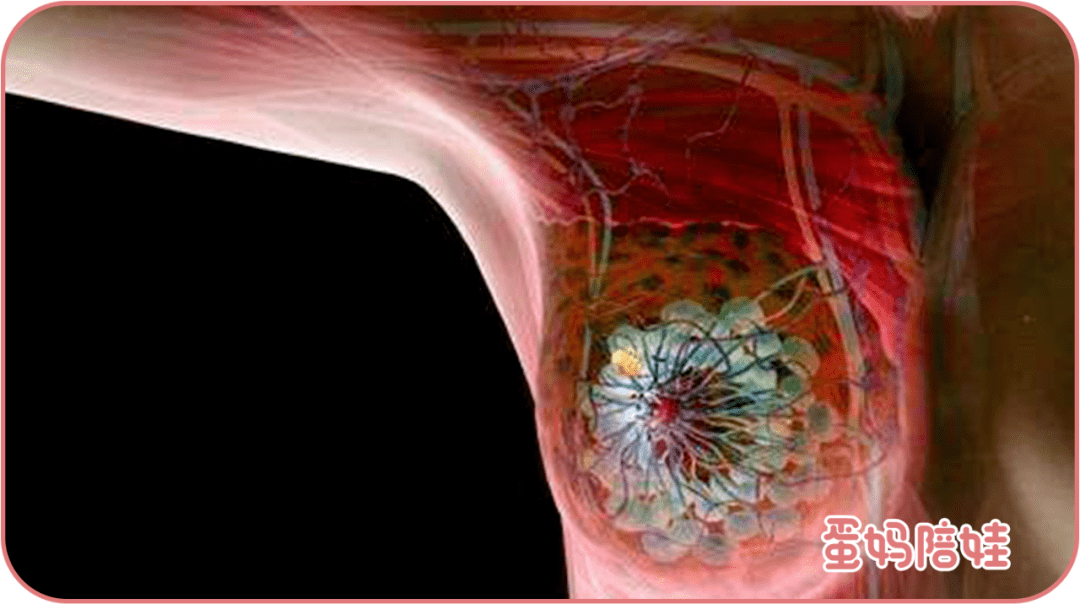 乳腺癌 乳腺癌多为单侧单发的肿块,质地坚硬,边缘不规则,表面不光滑