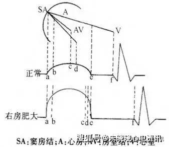 全面解读心脏肥大心电图诊断!