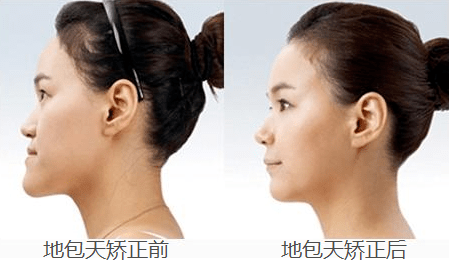 没下巴,脸型不对称.你首先想到整容?