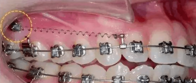 矫正牙齿打骨钉会有风险吗?