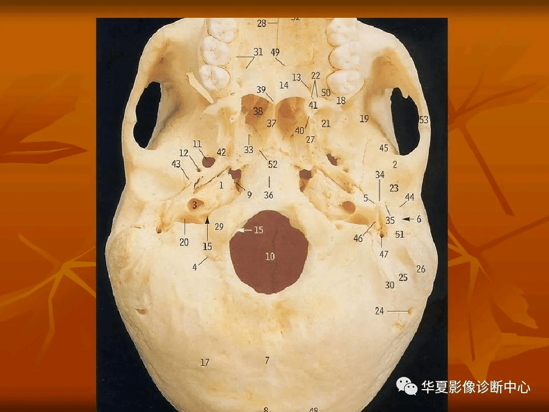 颅底ct高清图解 常见骨折部位图示