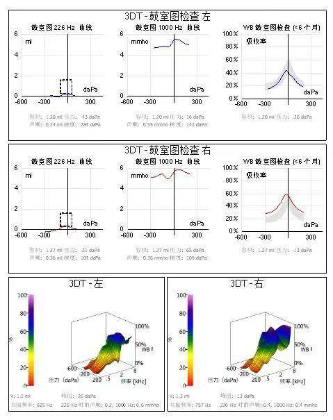 1000 hz 鼓室曲线 226 hz 鼓室曲线 鼓室 压力 dapa 声顺值 ml 左耳