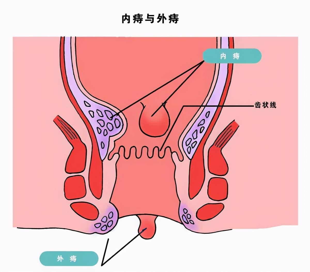 三,混合痔