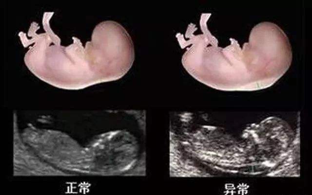世界唐氏综合征日：三类孕妇易怀唐氏儿,两项产检筛查很关键