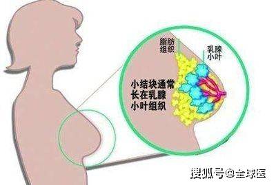 全球医:因乳腺癌行双乳切除术后,为什么我等了十年才进行乳房再造?