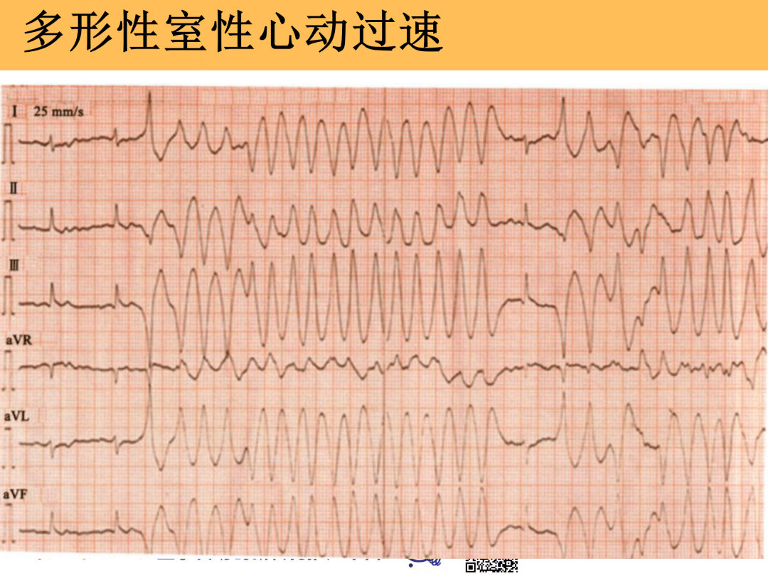 恶性心律失常心电图的识别与处理