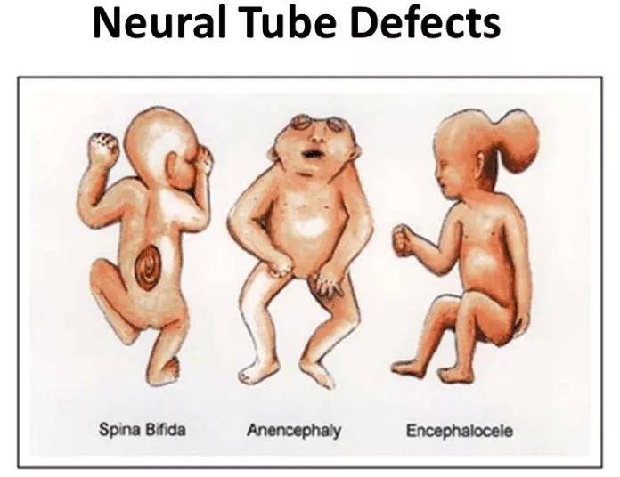 经研究分析后总结发现,这些被称作"怪胎"的婴儿,多患有神经管缺陷(ntd