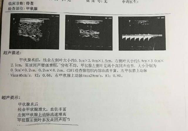 现在甲状腺结节患者很多,拿到甲状腺超声检查报告,很多人不太能够看