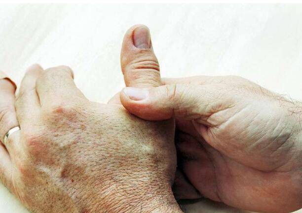 3,大拇指根部青筋 大拇指出现青筋可能是 冠状动脉硬化 造成的,主要