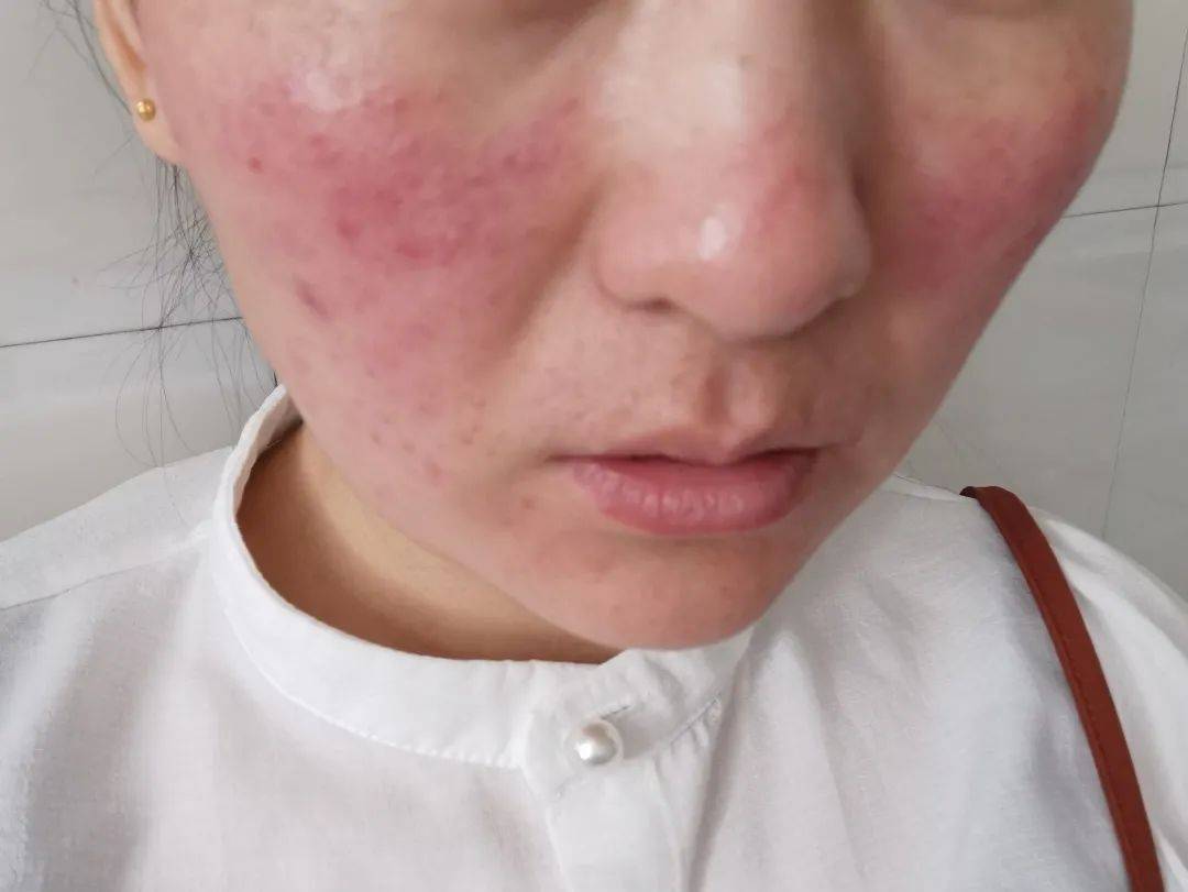 面部过敏 来自搜狐网