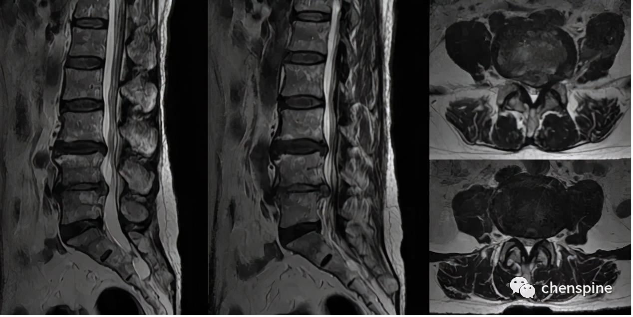 腰椎mri: 腰椎退变l3/4,l4/5椎间盘突出,腰椎管狭窄