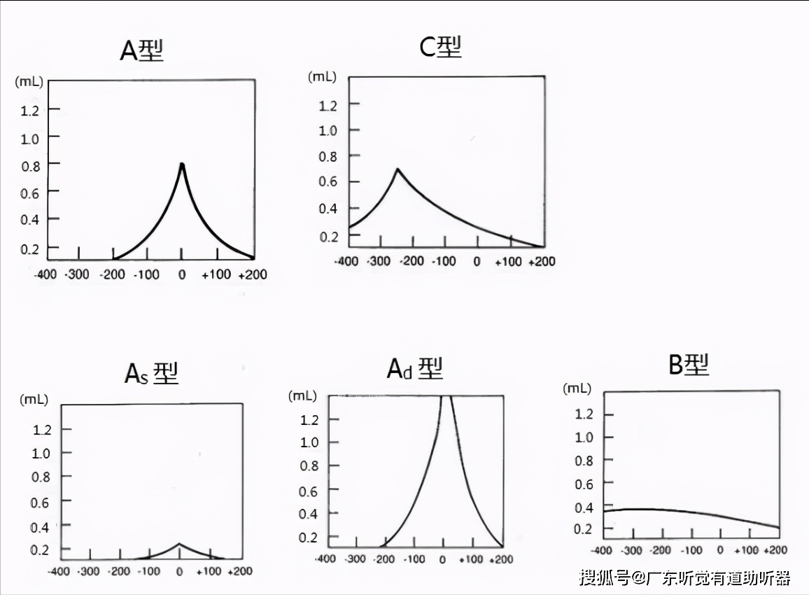 三,c型鼓室声导抗平缓,峰值小于0.3 ml,多见于鼓室积液,耵聍堵塞等.