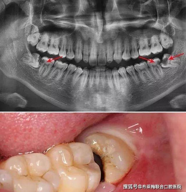 牙痛想补牙,医生却说需要拔除,究竟什么情况下牙齿需要拔掉呢?