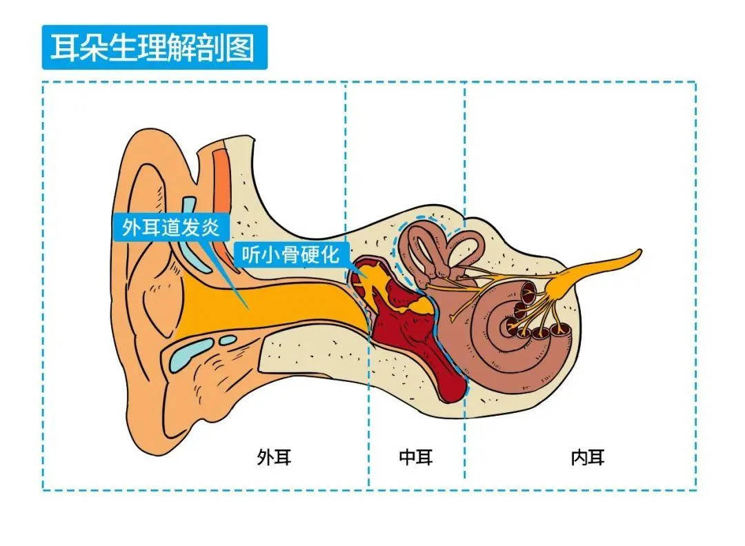 听力损失后要怎样恢复?_中耳