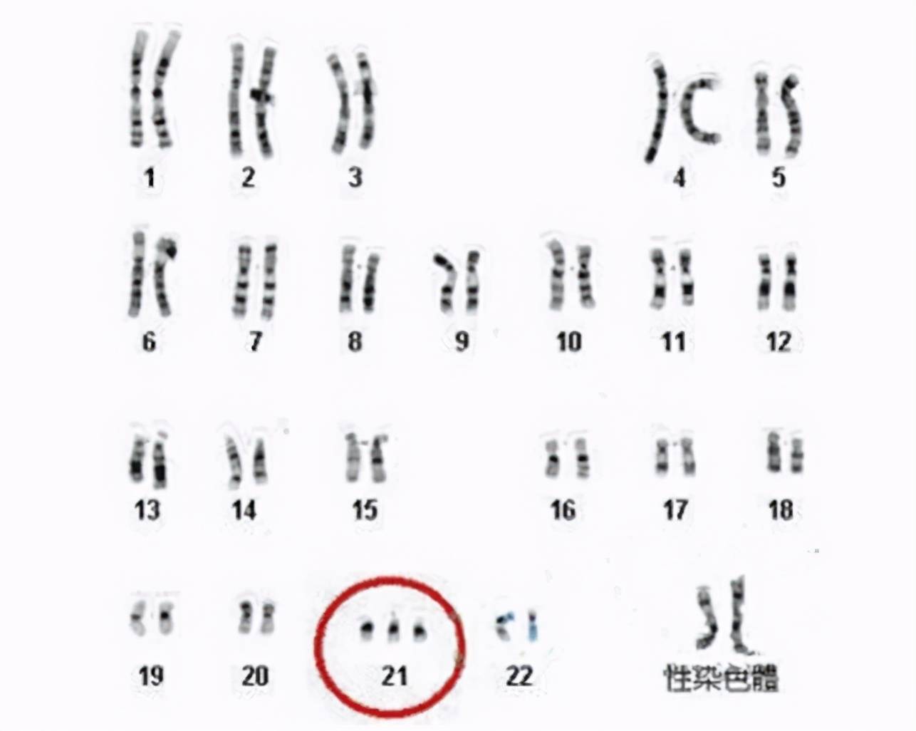 有些致病基因就存在导致唐氏儿的一些特征相似