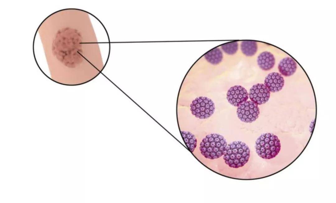 疣来疣去知多少,日常护理你要这么做!