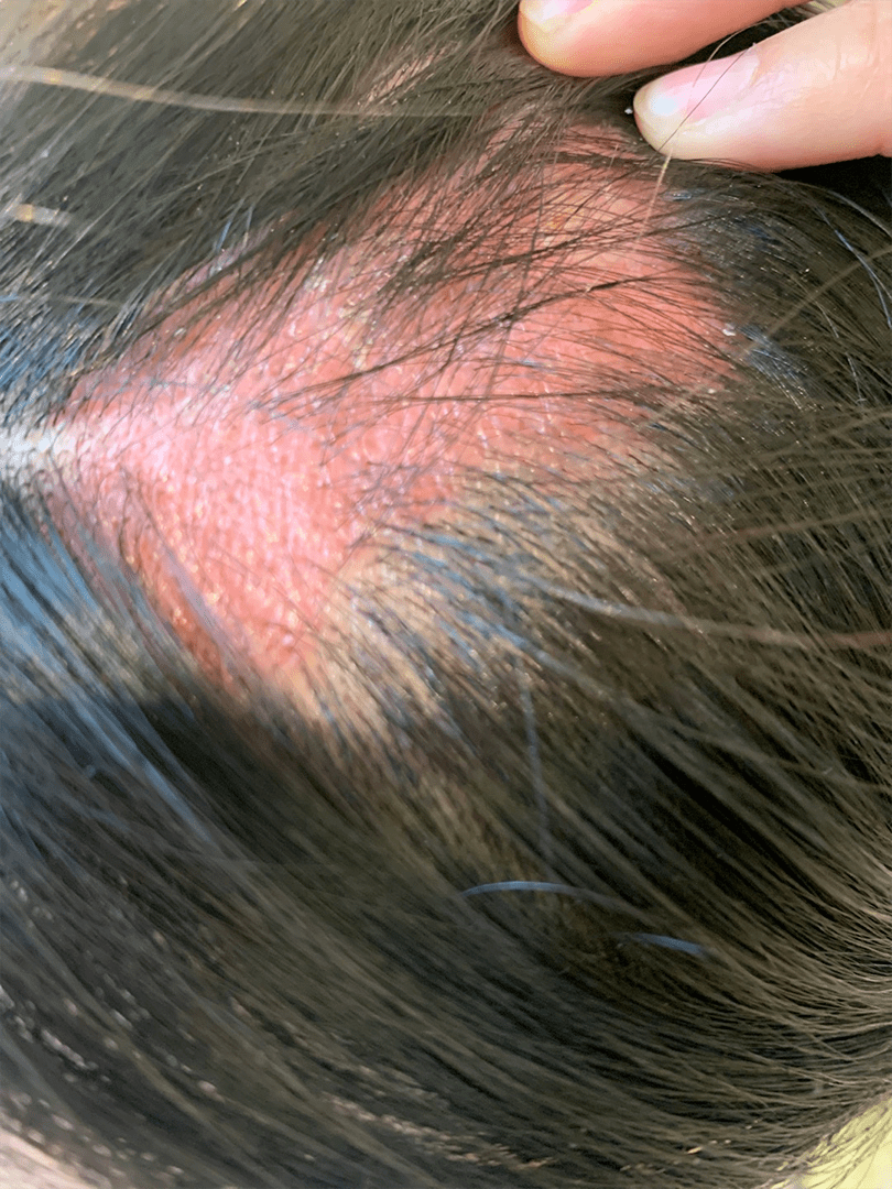 初诊时,我通过详细的问诊,总结x小姐具有以下这些症状:头皮处发红