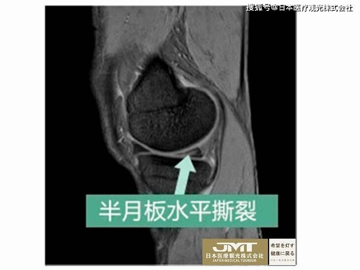 徒手试验有,apley试验,mcmurray试验,过伸试验(hyperextension test)