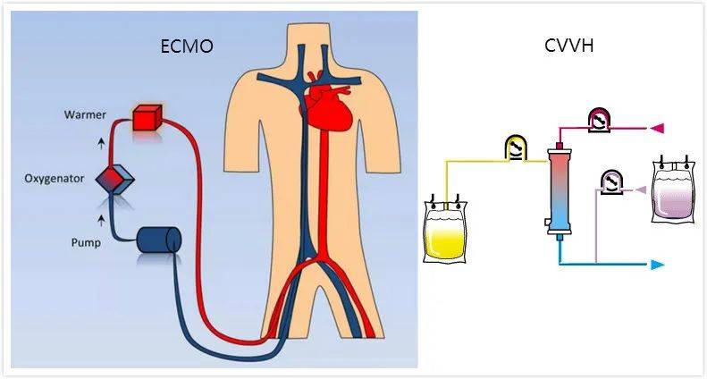 新冠疫情抢救中,不可或缺的仪器【ecmo】核心部件完成