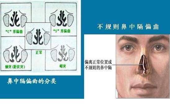 鼻中隔偏曲手术后怎么护理