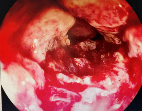 陕西省中医医院脾胃一科完成一例高难度内镜下食管癌支架植入术
