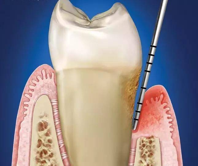 为什么医生还要我做"龈下刮治"?