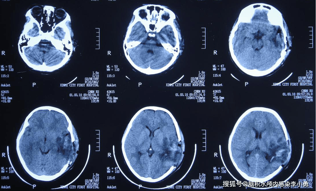 2, 第二次入院治疗经过(即第一次第二家医院) 术后患者恢复良好,因