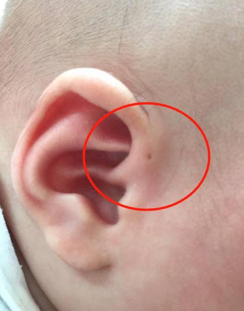 原创宝宝耳朵上有小孔,是"小福星"吗?日常护理不小心,娃可要受罪