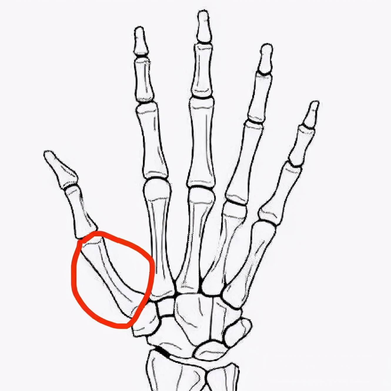 红色圈中的为第一掌骨,漂浮拇患者缺失了这根骨头