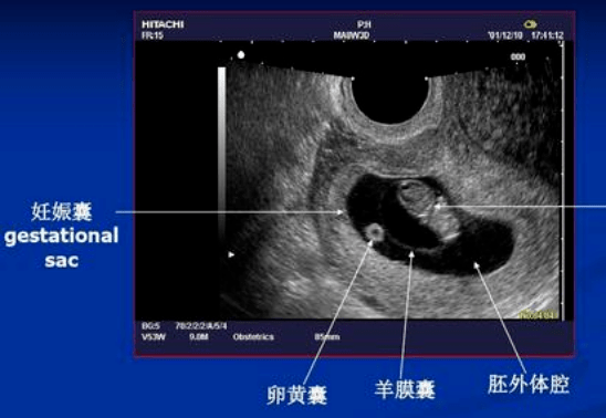 孕早期判断胎儿发育得好不好,看5个B超指标3个表现,孕妈收藏