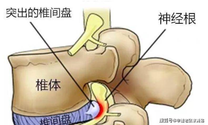 腰椎间盘突出症以腰4-5,腰5-骶1椎间盘发病率最高, 约占90%-96%.