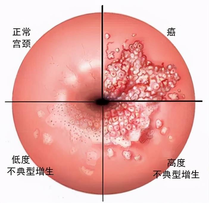 广州新市医院肿瘤1科丨什么是癌前病变?