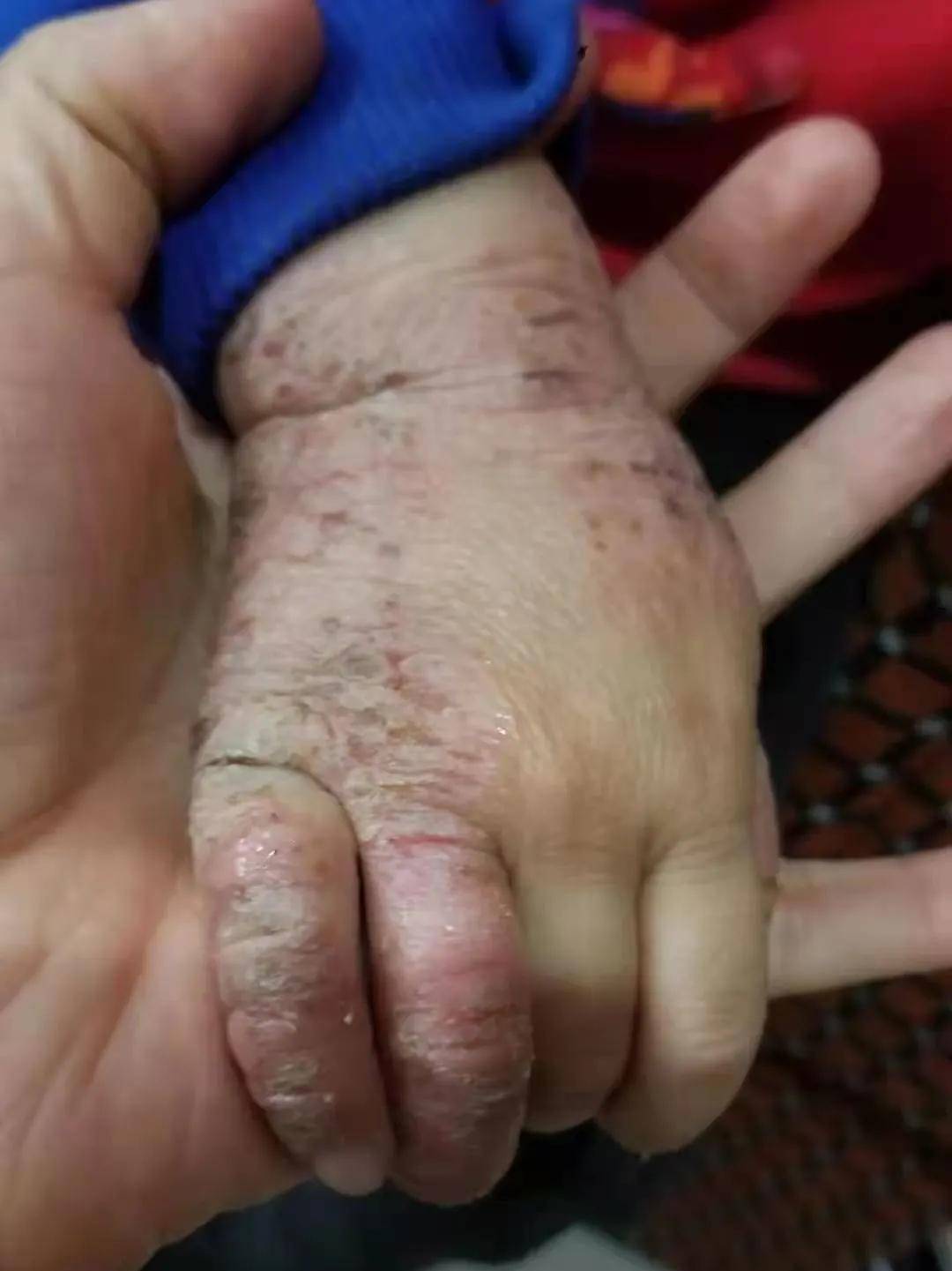 李金洁医师 | 抓抓抓,痒痒痒,干性湿疹困扰小宝宝_皮肤