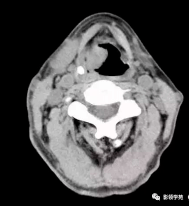 声带偏后方软组织肿块,侵犯后联合,喉旁间隙消失图3-5-12声门区癌b