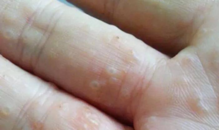 湿疹是一种常见的过敏性皮肤病可分为急性和慢性两种.