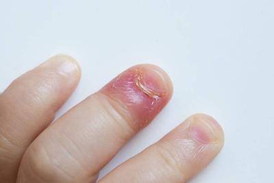 手指尖放血治疗末梢神经炎吗 如何治末梢神经有效