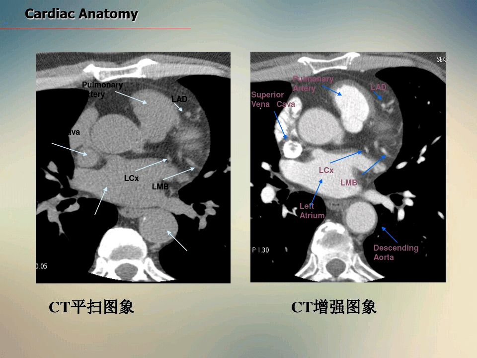 心脏ct断面解剖