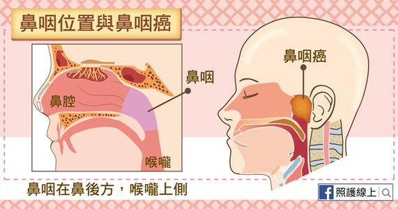 鼻咽癌有个别名叫"广东癌",早诊早治是关键!