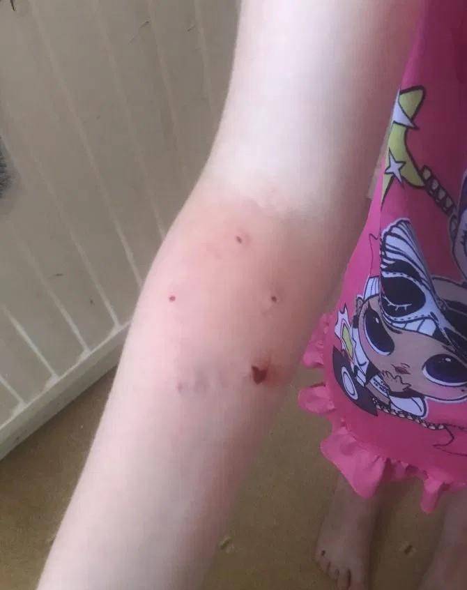 原创猫咪可爱但也会伤人!英一6岁女童被家养猫咬伤差点送命