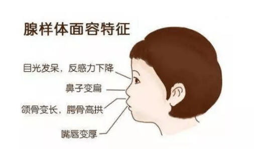 清鼻堂:腺样体肥大的危害?