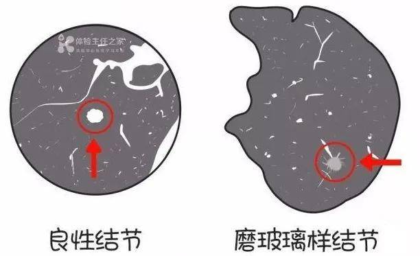 肺结节肺癌肿瘤专家9成以上都是良性