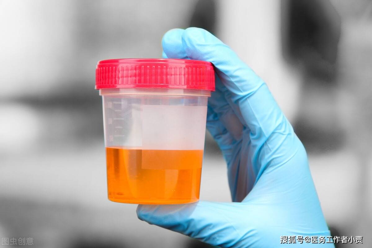 尿胆原阳性 来自搜狐网
