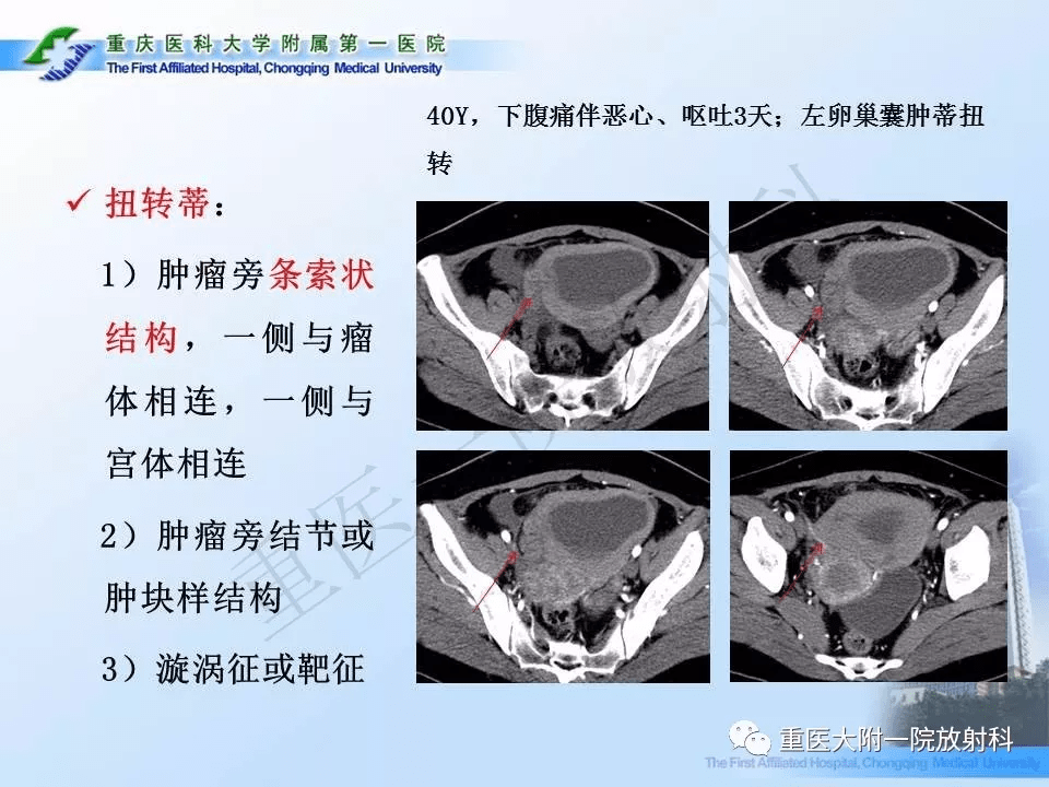 卵巢肿瘤蒂扭转的ct诊断