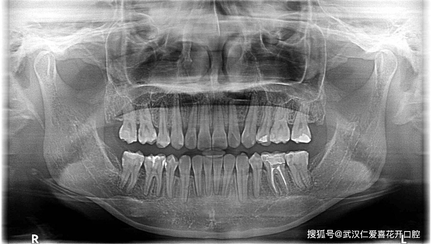 下颌骨全貌,上下颌牙列情况,牙槽骨情况;还有上颌窦腔,窦壁,窦底情况