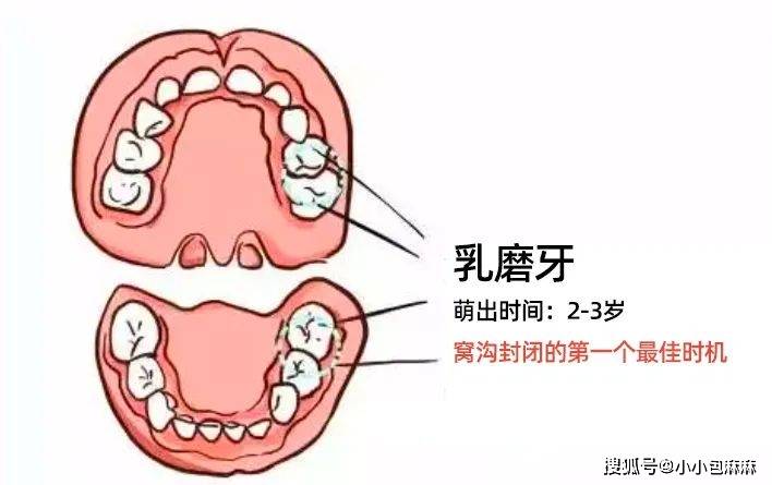 6—7岁,封闭第一恒磨牙(六龄齿)4颗