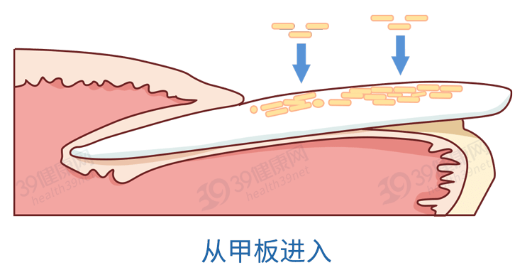 得了灰指甲怎么治?医生:坚持4种抗真菌药物,连根拔起不复发